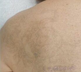 Tattoo Laser Entfernung Behandlung Vorher Nachher Triemer Aesthetics Dresden